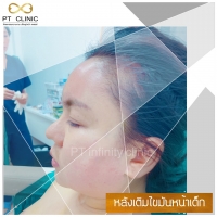 S__109551718.jpg - เติมไขมันหน้าเด็ก | https://ptinfinity.com