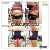 S__131678338.jpg - ดูดไขมัน แผลเล็กมาก เจ็บน้อย ชิวชิว ไม่ต้องวางยา | https://ptinfinity.com
