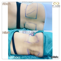 S__131678480.jpg - ดูดไขมัน แผลเล็กมาก เจ็บน้อย ชิวชิว ไม่ต้องวางยา | https://ptinfinity.com