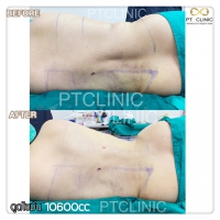 S__131678510.jpg - ดูดไขมัน แผลเล็กมาก เจ็บน้อย ชิวชิว ไม่ต้องวางยา | https://ptinfinity.com