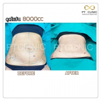 S__131678553.jpg - ดูดไขมัน แผลเล็กมาก เจ็บน้อย ชิวชิว ไม่ต้องวางยา | https://ptinfinity.com