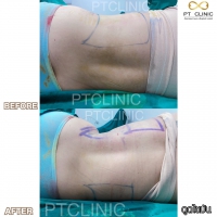 S__131678579.jpg - ดูดไขมัน แผลเล็กมาก เจ็บน้อย ชิวชิว ไม่ต้องวางยา | https://ptinfinity.com
