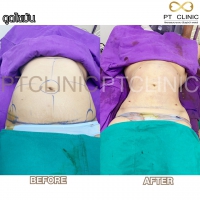 S__131678589.jpg - ดูดไขมัน แผลเล็กมาก เจ็บน้อย ชิวชิว ไม่ต้องวางยา | https://ptinfinity.com