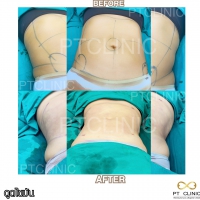 S__131678594.jpg - ดูดไขมัน แผลเล็กมาก เจ็บน้อย ชิวชิว ไม่ต้องวางยา | https://ptinfinity.com