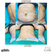 S__131678605.jpg - ดูดไขมัน แผลเล็กมาก เจ็บน้อย ชิวชิว ไม่ต้องวางยา | https://ptinfinity.com