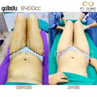 S__131678612.jpg - ดูดไขมัน แผลเล็กมาก เจ็บน้อย ชิวชิว ไม่ต้องวางยา | https://ptinfinity.com