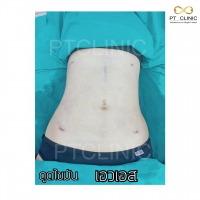 S__131678614.jpg - ดูดไขมัน แผลเล็กมาก เจ็บน้อย ชิวชิว ไม่ต้องวางยา | https://ptinfinity.com
