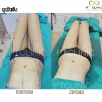 S__131678617.jpg - ดูดไขมัน แผลเล็กมาก เจ็บน้อย ชิวชิว ไม่ต้องวางยา | https://ptinfinity.com