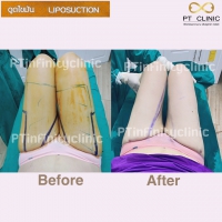 S__131891221.jpg - ดูดไขมัน แผลเล็กมาก เจ็บน้อย ชิวชิว ไม่ต้องวางยา | https://ptinfinity.com