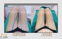 S__131891243.jpg - ดูดไขมัน แผลเล็กมาก เจ็บน้อย ชิวชิว ไม่ต้องวางยา | https://ptinfinity.com