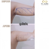 S__131891259.jpg - ดูดไขมัน แผลเล็กมาก เจ็บน้อย ชิวชิว ไม่ต้องวางยา | https://ptinfinity.com