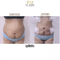 S__131891260.jpg - ดูดไขมัน แผลเล็กมาก เจ็บน้อย ชิวชิว ไม่ต้องวางยา | https://ptinfinity.com