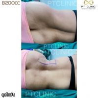 S__131891286.jpg - ดูดไขมัน แผลเล็กมาก เจ็บน้อย ชิวชิว ไม่ต้องวางยา | https://ptinfinity.com