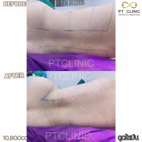 S__131891320.jpg - ดูดไขมัน แผลเล็กมาก เจ็บน้อย ชิวชิว ไม่ต้องวางยา | https://ptinfinity.com