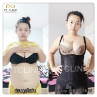 S__131891346.jpg - ดูดไขมัน แผลเล็กมาก เจ็บน้อย ชิวชิว ไม่ต้องวางยา | https://ptinfinity.com