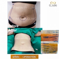 a5.jpg - ดูดไขมัน แผลเล็กมาก เจ็บน้อย ชิวชิว ไม่ต้องวางยา | https://ptinfinity.com
