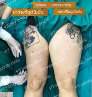 b2.jpg - ดูดไขมัน แผลเล็กมาก เจ็บน้อย ชิวชิว ไม่ต้องวางยา | https://ptinfinity.com
