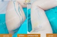 b5.jpg - ดูดไขมัน แผลเล็กมาก เจ็บน้อย ชิวชิว ไม่ต้องวางยา | https://ptinfinity.com