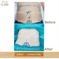 b6.jpg - ดูดไขมัน แผลเล็กมาก เจ็บน้อย ชิวชิว ไม่ต้องวางยา | https://ptinfinity.com
