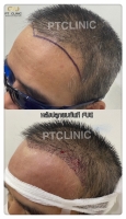 S__146047009.jpg - ปลูกผม | https://ptinfinity.com