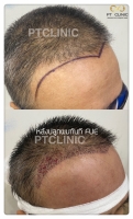 S__146047012.jpg - ปลูกผม | https://ptinfinity.com