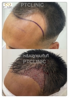 S__146047031.jpg - ปลูกผม | https://ptinfinity.com