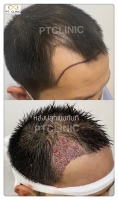 S__146047039.jpg - ปลูกผม | https://ptinfinity.com