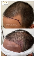 S__146047051.jpg - ปลูกผม | https://ptinfinity.com
