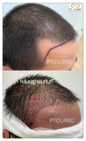 S__146047053.jpg - ปลูกผม | https://ptinfinity.com