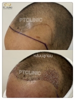 S__146047061.jpg - ปลูกผม | https://ptinfinity.com