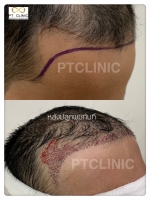 S__146047066.jpg - ปลูกผม | https://ptinfinity.com