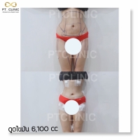 S__146047109.jpg - บริการดูดไขมัน 3,800 CC | https://ptinfinity.com