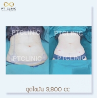 S__146047113.jpg - บริการดูดไขมัน 3,800 CC | https://ptinfinity.com