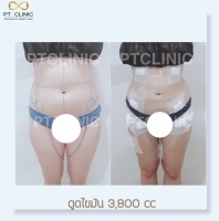 S__146047115.jpg - บริการดูดไขมัน 3,800 CC | https://ptinfinity.com