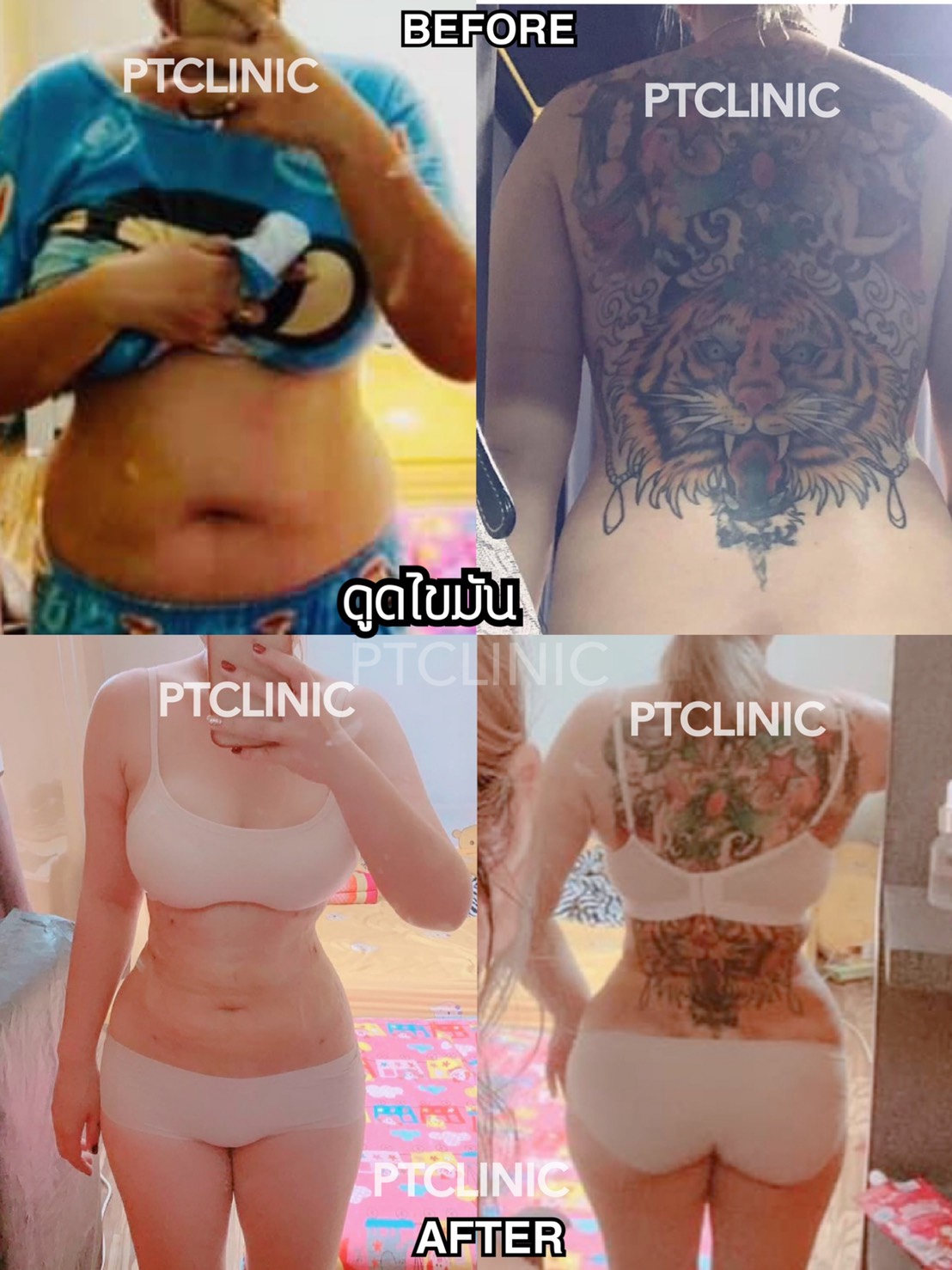 3 - https://ptinfinity.com | PT CLINIC ศัลยกรรมความงาม ปรับรูปหน้า เลเซอร์