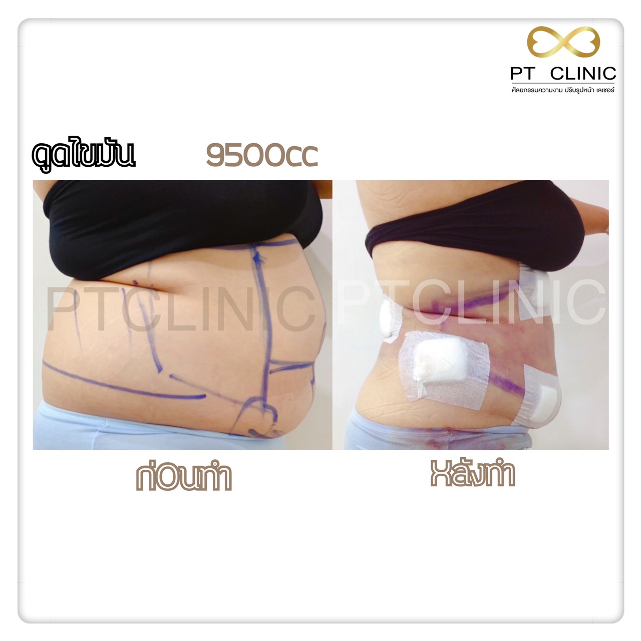 7 - https://ptinfinity.com | PT CLINIC ศัลยกรรมความงาม ปรับรูปหน้า เลเซอร์