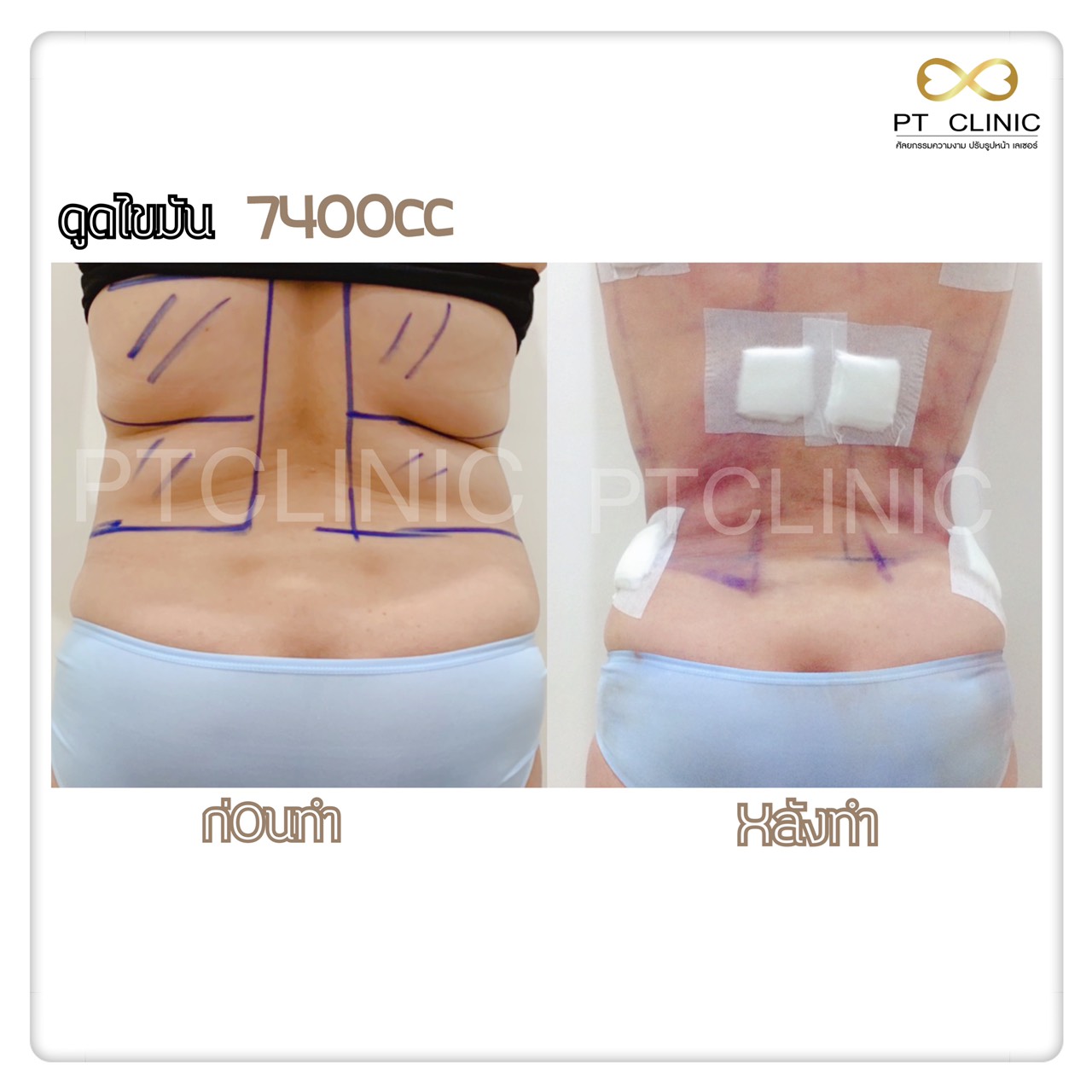 9 - https://ptinfinity.com | PT CLINIC ศัลยกรรมความงาม ปรับรูปหน้า เลเซอร์