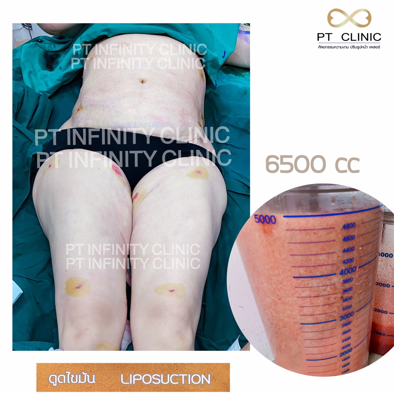 a10 - https://ptinfinity.com | PT CLINIC ศัลยกรรมความงาม ปรับรูปหน้า เลเซอร์