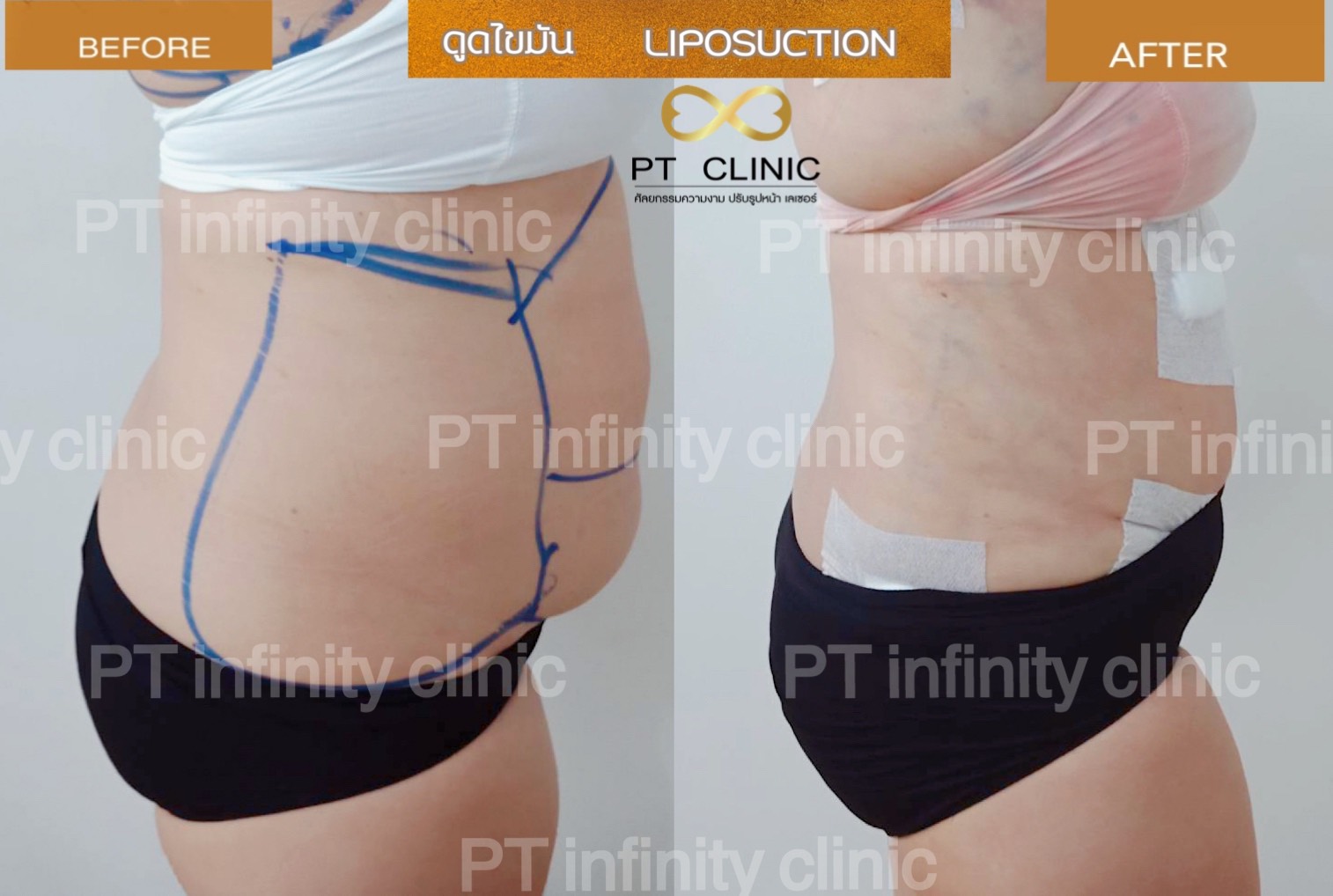 b4 - https://ptinfinity.com | PT CLINIC ศัลยกรรมความงาม ปรับรูปหน้า เลเซอร์