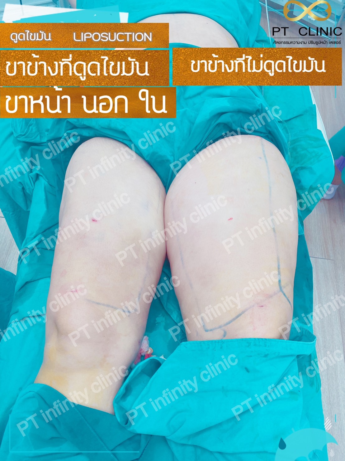 b7 - https://ptinfinity.com | PT CLINIC ศัลยกรรมความงาม ปรับรูปหน้า เลเซอร์